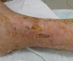 Ulcer trofic pe picior tratat cu remedii folclorice