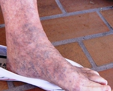 Ulcer trofic pe picior tratat cu remedii folclorice