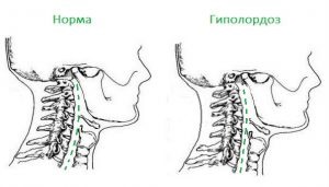 Exerciții pentru gipolordoza coloanei vertebrale cervicale și lombare