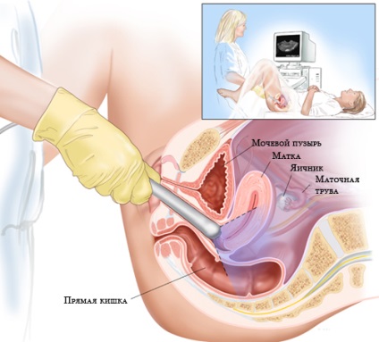 Uzi de preparare de organe de sex feminin (pentru uzi de organe mici ale pelvisului)