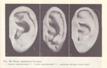 Variații ale tuberculilor auriculei (tuberculul lui Darwin), reflexoterapie