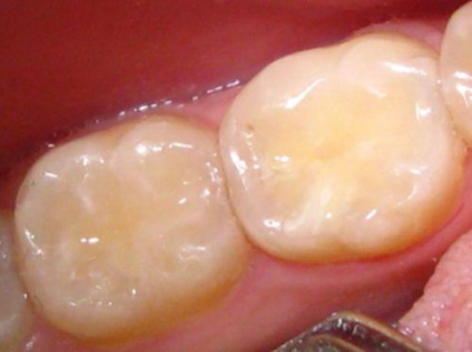 Tipurile de titluri de umplere a dinților, pe care dentistul le pune, beneficiază