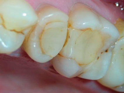 Tipurile de titluri de umplere a dinților, pe care dentistul le pune, beneficiază