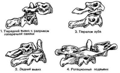 Dislocarea articulației gâtului atlanto-osos