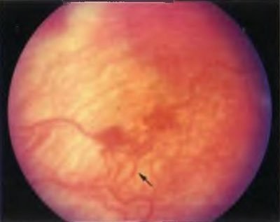 Infecții retiniane congenitale și copilarie - incontinență pigmentară