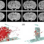 schema BEACOPP Chimioterapia cu limfom Hodgkin