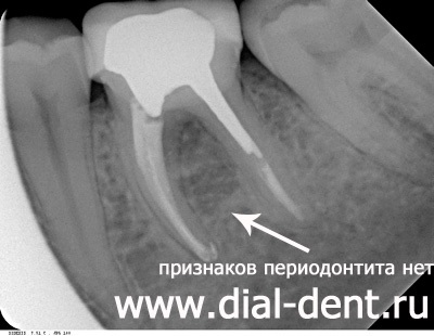 Хронічний періодонтит - діагностика і лікування