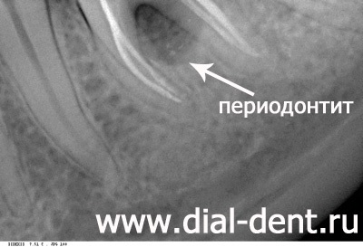 Parodontita cronică - diagnostic și tratament