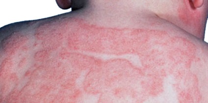 Eczemă alergică la tratamentul mâinilor
