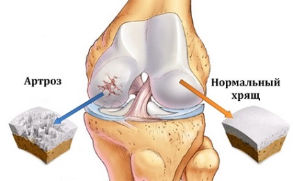 Osteoartrita simptomelor articulației genunchiului, tratament și prevenire