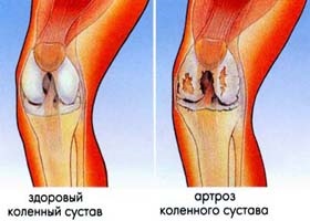 Osteoartrita simptome, tratament, diferență de artrită