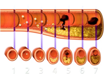 Az aorta érelmeszesedése, tünetei, kezelése, megelőzése