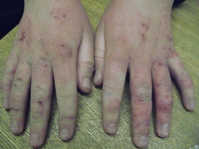 Atópiás dermatitis kezelés és megelőzés