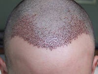 Metoda fără sudură a transplantului de păr (fue)