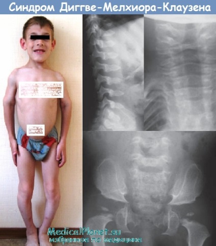 Boli cu deformări severe ale coloanei vertebrale Goldenhar, sindroame diggve-melchior-clausen