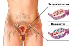 Ovarii ache în timpul sarcinii - motive pentru modul de a trata