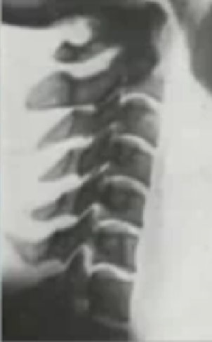 Ceea ce este periculos este tracțiunea spinării tracțiunea coloanei vertebrale periculoase