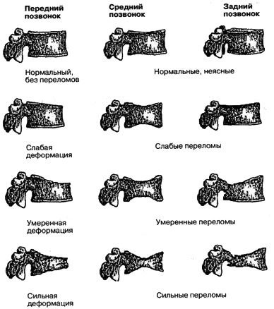 Diagnosticul osteoporozei - reumatologie - chirurgie și tratament