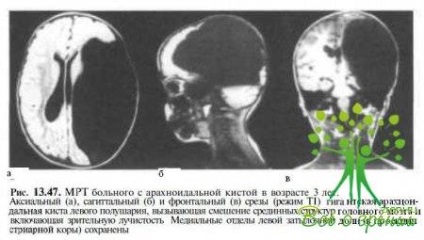 Displazia nervului optic