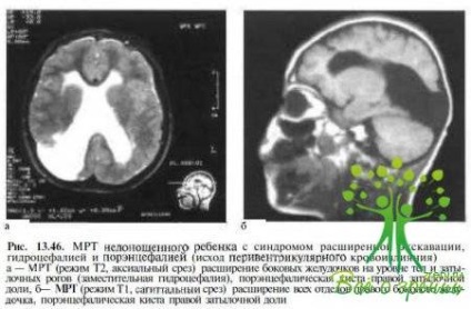 Дисплазія диска зорового нерва