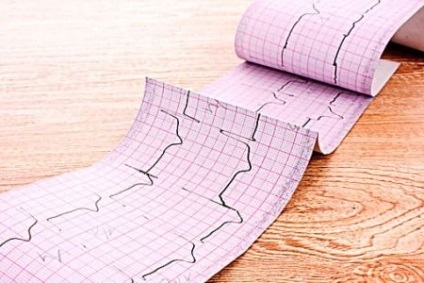 Ekg cu fotografie infarct miocardic cu decodificare