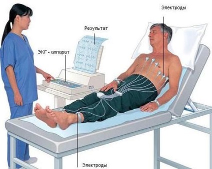 ЕКГ миокарден инфаркт снимка с подробности