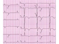 ЕКГ миокарден инфаркт снимка с подробности