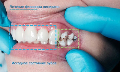 Fluoroza simptomelor, cauzelor, tratamentului, prevenirii și diagnosticării bolii