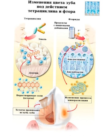 Fluoroza simptomelor, cauzelor, tratamentului, prevenirii și diagnosticării bolii