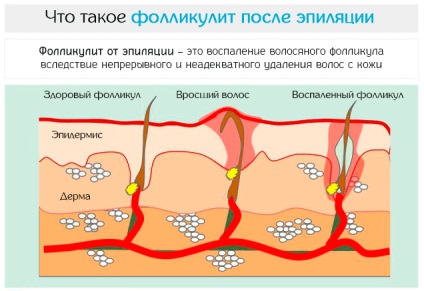 Folliculita după epilare - cauze și remedii naturale