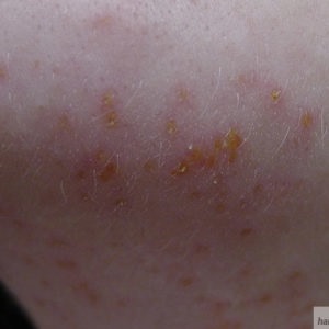 Folliculitis (a tüszők gyulladása), mint bármilyen szőrtelenítés és szőrtelenítés szövődménye, szőrös kérdés