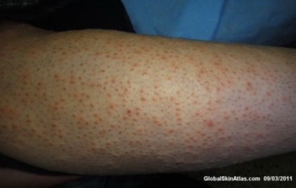 Folliculitis (a tüszők gyulladása), mint bármilyen szőrtelenítés és szőrtelenítés szövődménye, szőrös kérdés