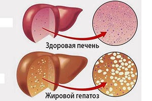 Hepatoza la femeile gravide afectează fătul și efectele asupra copilului