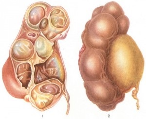 Hydronephrosis la copii clasificare, simptome, diagnostic, tratament