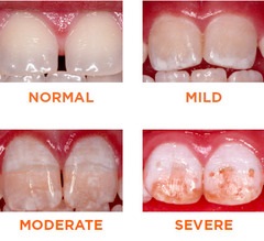 Hiperplazia din smalțul dinților provoacă dezvoltarea, tratamentul, prevenirea