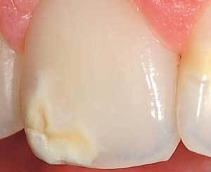 Hiperplazia din smalțul dinților provoacă dezvoltarea, tratamentul, prevenirea