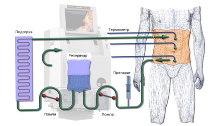 Hyperthermic chimioterapie intraperitoneală (hipec) în cele mai bune clinici în străinătate prețuri, recenzii,