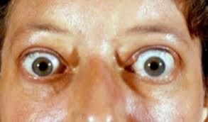 Simptome oculare la tirotoxicoză