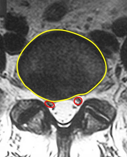 Disc herniat