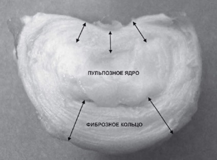 Disc herniat