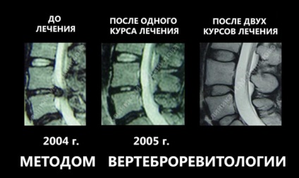 Disc herniat