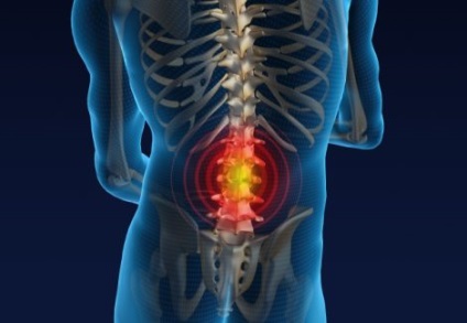 Disc herniat