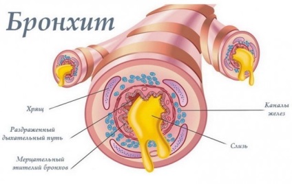 Thoracic tuse uscată, fără febră și umflătură în stern, cum se tratează