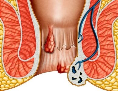 Cum arată hemoroizii la femei, de ce și de ce apare
