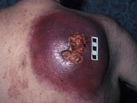 Cum arată melanomul o fotografie, cum să distingi de un mol