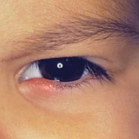 Cum de a vindeca o raceala in ochiul unei raceli in ochiul copilului