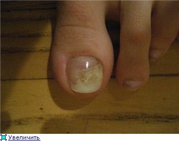 köröm gomba a hüvelykujj okozza a lábak izzadt láb a körömgombától