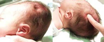Kefalogematoma la nou-născuții privind tratamentul capului, puncție și consecințe
