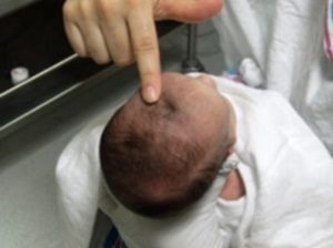 Kefalogematoma la nou-născuții privind tratamentul capului, puncție și consecințe
