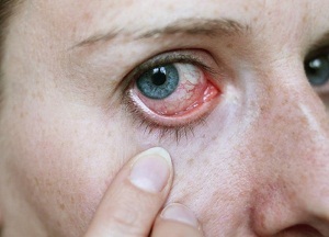Keratita este ceea ce este și cum să tratați forma alergică a bolii